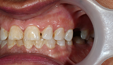 Before - Natural Smiles Implant & Cosmetic Dentistry