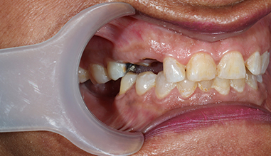 Before - Natural Smiles Implant & Cosmetic Dentistry