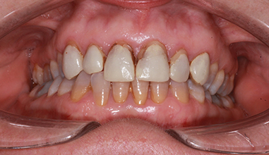 Before - Natural Smiles Implant & Cosmetic Dentistry