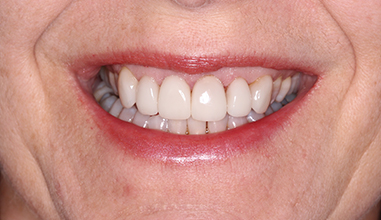 After - Natural Smiles Implant & Cosmetic Dentistry
