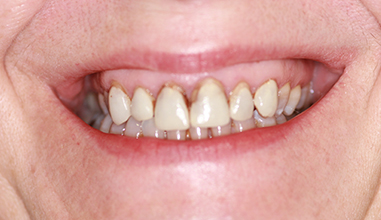 Before - Natural Smiles Implant & Cosmetic Dentistry