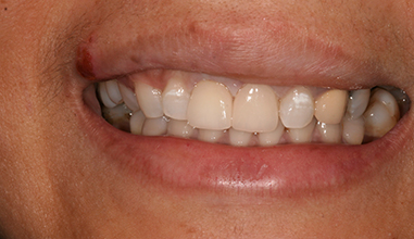 After - Natural Smiles Implant & Cosmetic Dentistry