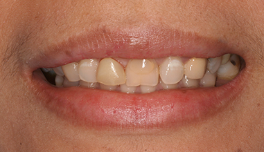 Before - Natural Smiles Implant & Cosmetic Dentistry