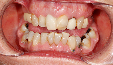 Before - Natural Smiles Implant & Cosmetic Dentistry