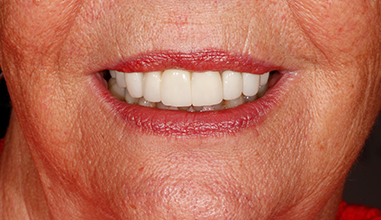 After - Natural Smiles Implant & Cosmetic Dentistry