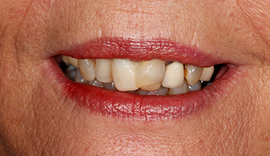 Before - Natural Smiles Implant & Cosmetic Dentistry