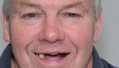 Before - Natural Smiles Implant & Cosmetic Dentistry