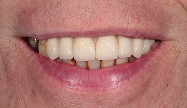 After - Natural Smiles Implant & Cosmetic Dentistry