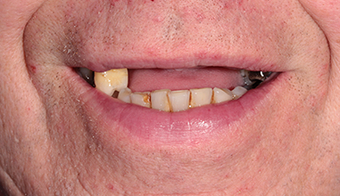 Before - Natural Smiles Implant & Cosmetic Dentistry