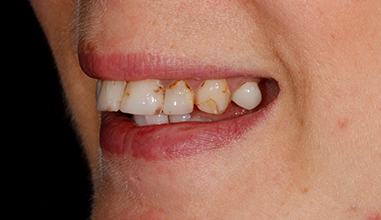 Before - Natural Smiles Implant & Cosmetic Dentistry