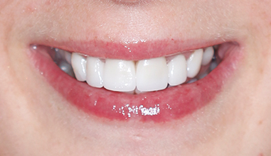 After - Natural Smiles Implant & Cosmetic Dentistry