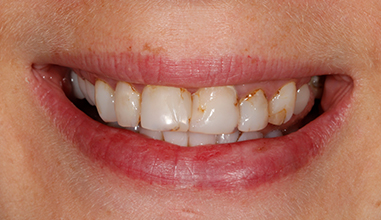 Before - Natural Smiles Implant & Cosmetic Dentistry