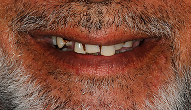 Before - Natural Smiles Implant & Cosmetic Dentistry