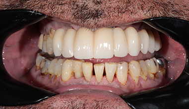 After - Natural Smiles Implant & Cosmetic Dentistry