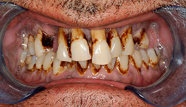 Before - Natural Smiles Implant & Cosmetic Dentistry