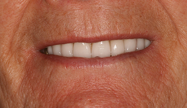After - Natural Smiles Implant & Cosmetic Dentistry