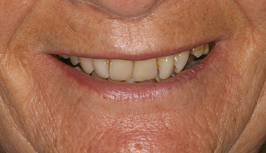 Before - Natural Smiles Implant & Cosmetic Dentistry
