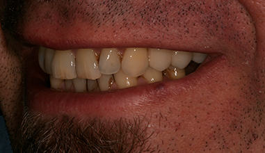 After - Natural Smiles Implant & Cosmetic Dentistry