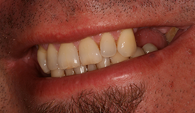 Before - Natural Smiles Implant & Cosmetic Dentistry