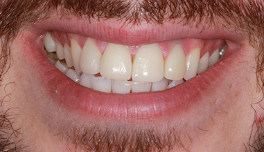 After - Natural Smiles Implant & Cosmetic Dentistry