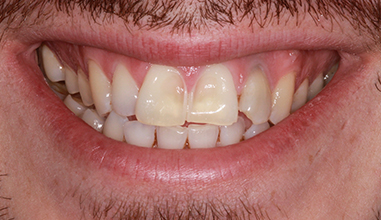 Before - Natural Smiles Implant & Cosmetic Dentistry