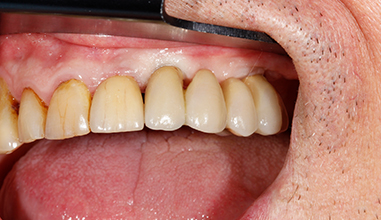 After - Natural Smiles Implant & Cosmetic Dentistry