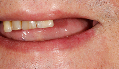 Before - Natural Smiles Implant & Cosmetic Dentistry