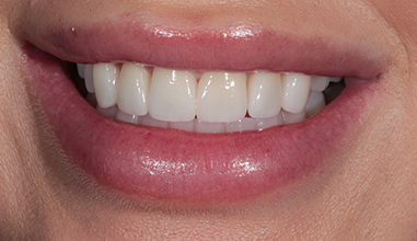 After - Natural Smiles Implant & Cosmetic Dentistry