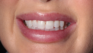 Before - Natural Smiles Implant & Cosmetic Dentistry