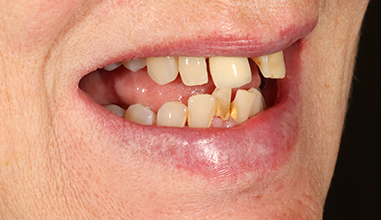 Before - Natural Smiles Implant & Cosmetic Dentistry