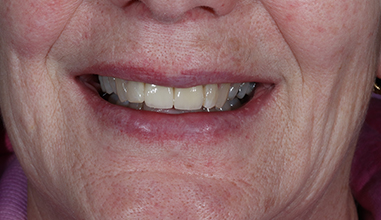 After - Natural Smiles Implant & Cosmetic Dentistry