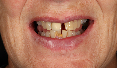 Before - Natural Smiles Implant & Cosmetic Dentistry