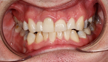 Before - Natural Smiles Implant & Cosmetic Dentistry