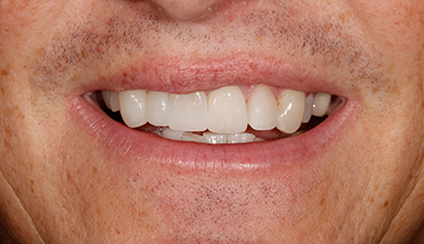 After - Natural Smiles Implant & Cosmetic Dentistry