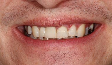 Before - Natural Smiles Implant & Cosmetic Dentistry