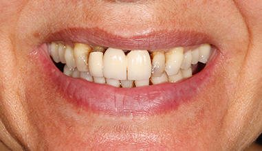 Before - Natural Smiles Implant & Cosmetic Dentistry