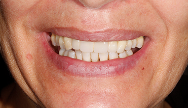After - Natural Smiles Implant & Cosmetic Dentistry