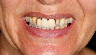 Before - Natural Smiles Implant & Cosmetic Dentistry