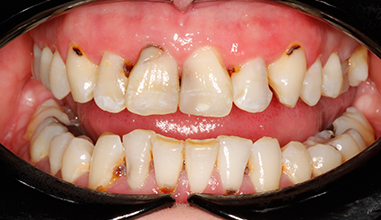 Before - Natural Smiles Implant & Cosmetic Dentistry