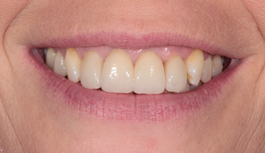 After - Natural Smiles Implant & Cosmetic Dentistry