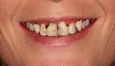 Before - Natural Smiles Implant & Cosmetic Dentistry