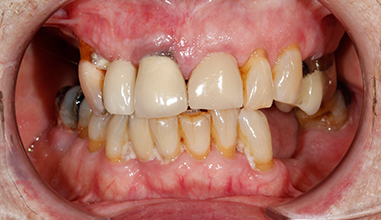 Before - Natural Smiles Implant & Cosmetic Dentistry