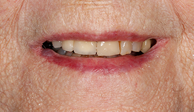 After - Natural Smiles Implant & Cosmetic Dentistry