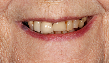 Before - Natural Smiles Implant & Cosmetic Dentistry