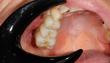 After - Natural Smiles Implant & Cosmetic Dentistry