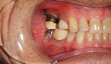 Before - Natural Smiles Implant & Cosmetic Dentistry