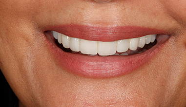 After - Natural Smiles Implant & Cosmetic Dentistry