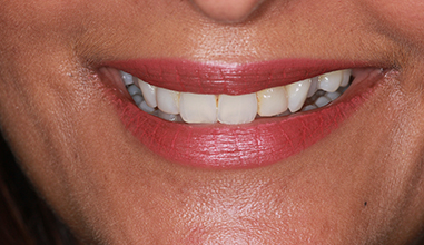 Before - Natural Smiles Implant & Cosmetic Dentistry