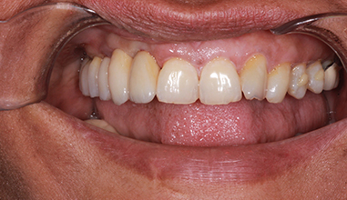 After - Natural Smiles Implant & Cosmetic Dentistry