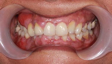 Before - Natural Smiles Implant & Cosmetic Dentistry